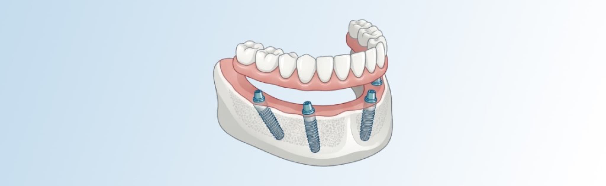 Schematische Darstellung All-on-4: Unterkiefer mit vier Implantaten und fester Zahnreihe auf Brückenkonstruktion