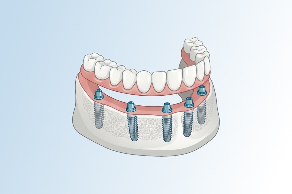 Schematische Darstellung All-on-6: Unterkiefer mit sechs Implantaten und fester Zahnreihe auf Brückenkonstruktion