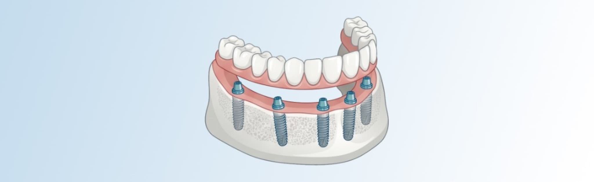 Schematische Darstellung All-on-6: Unterkiefer mit sechs Implantaten und fester Zahnreihe auf Brückenkonstruktion