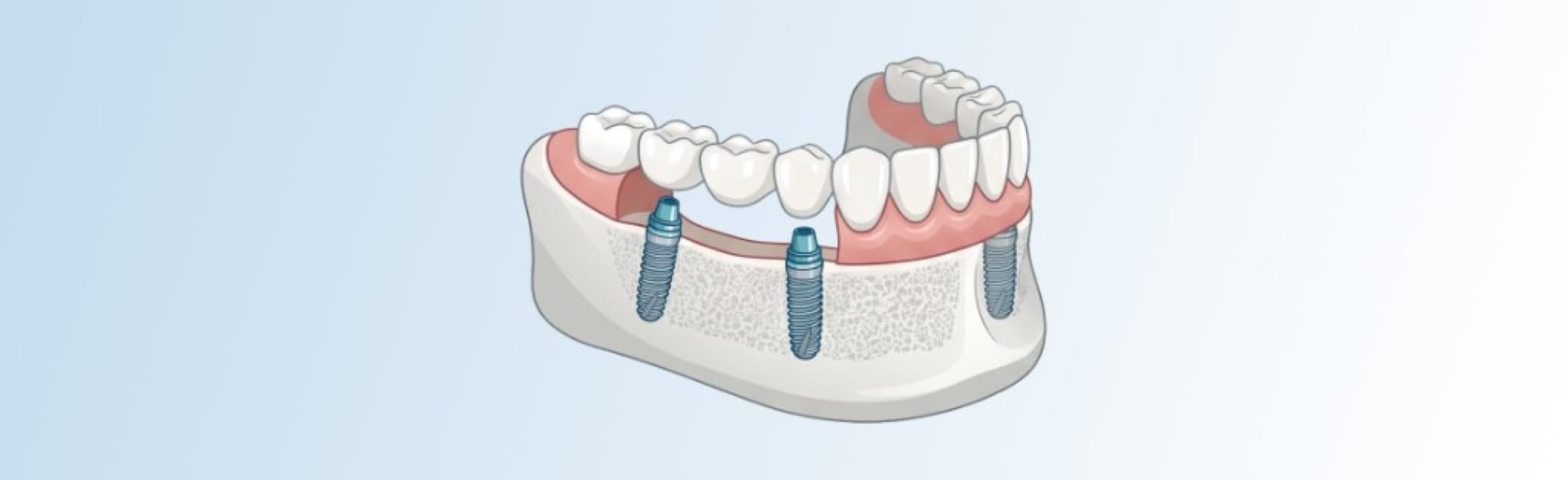 Schematische Darstellung: Kiefersegment mit Implantaten und fester Brückenversorgung auf Implantatpfeilern