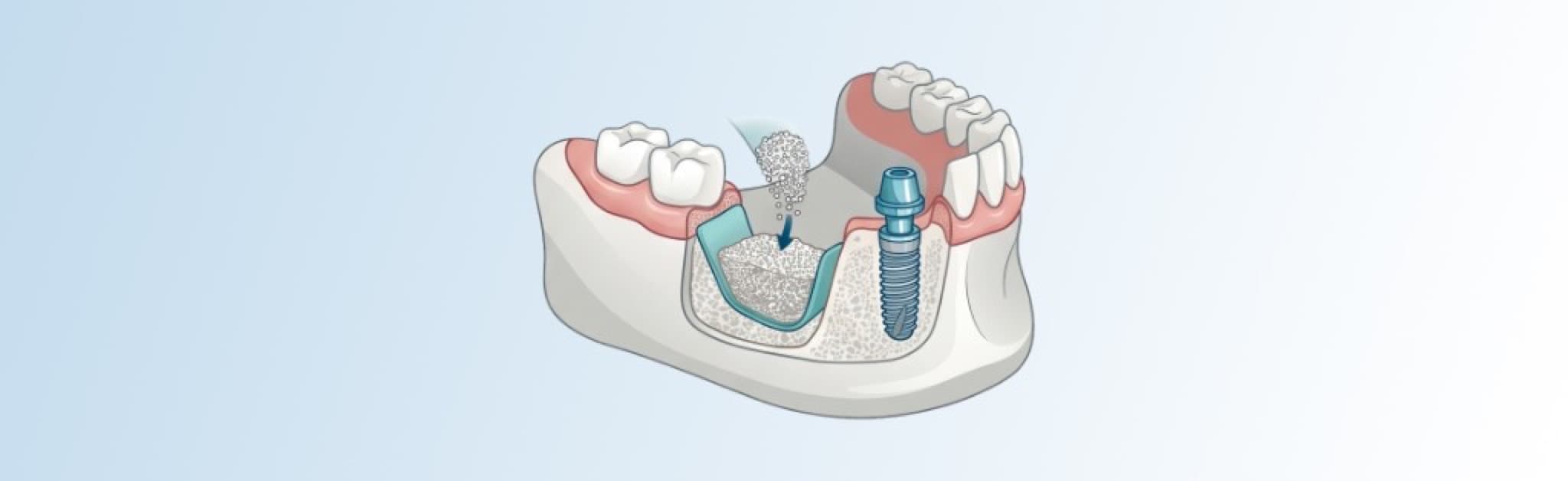 Schematische Darstellung: Kiefersegment mit geführter Knochenregeneration und benachbart gesetztem Implantat