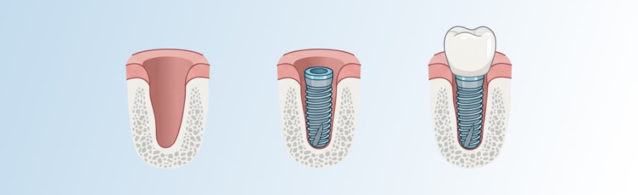 Schematische Darstellung in drei Schritten: Alveole, gesetztes Implantat im Kieferknochen und Krone auf Implantat