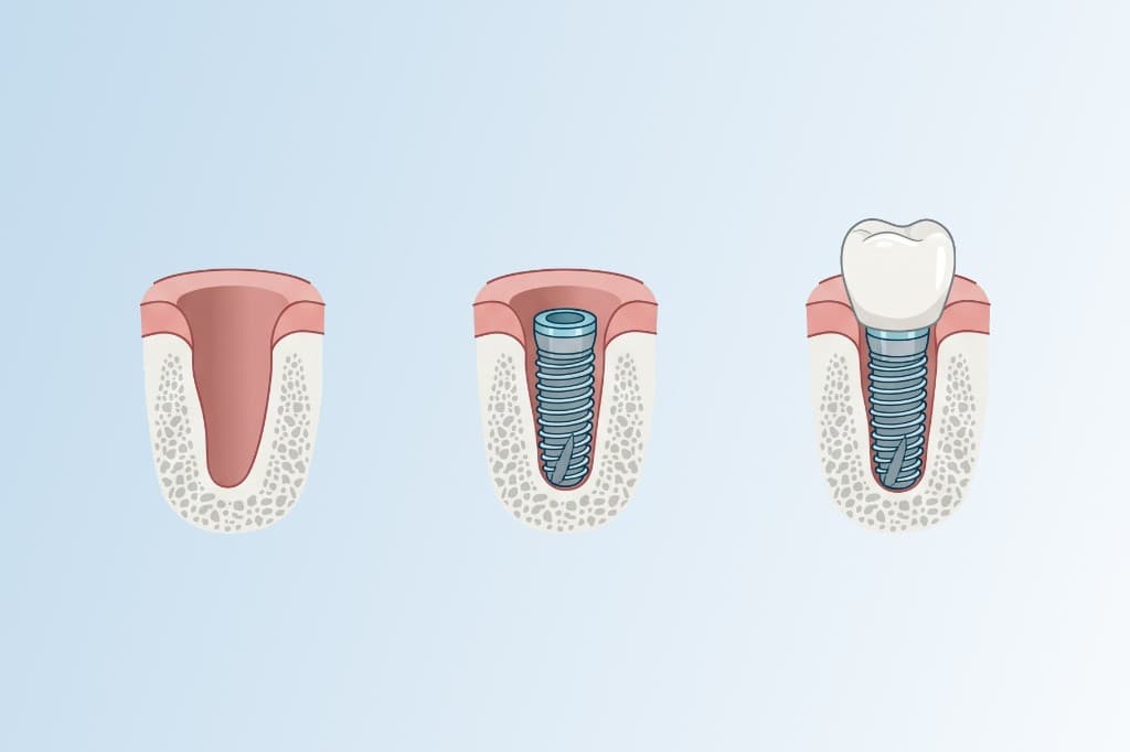Schematische Darstellung in drei Schritten: Alveole, gesetztes Implantat im Kieferknochen und Krone auf Implantat
