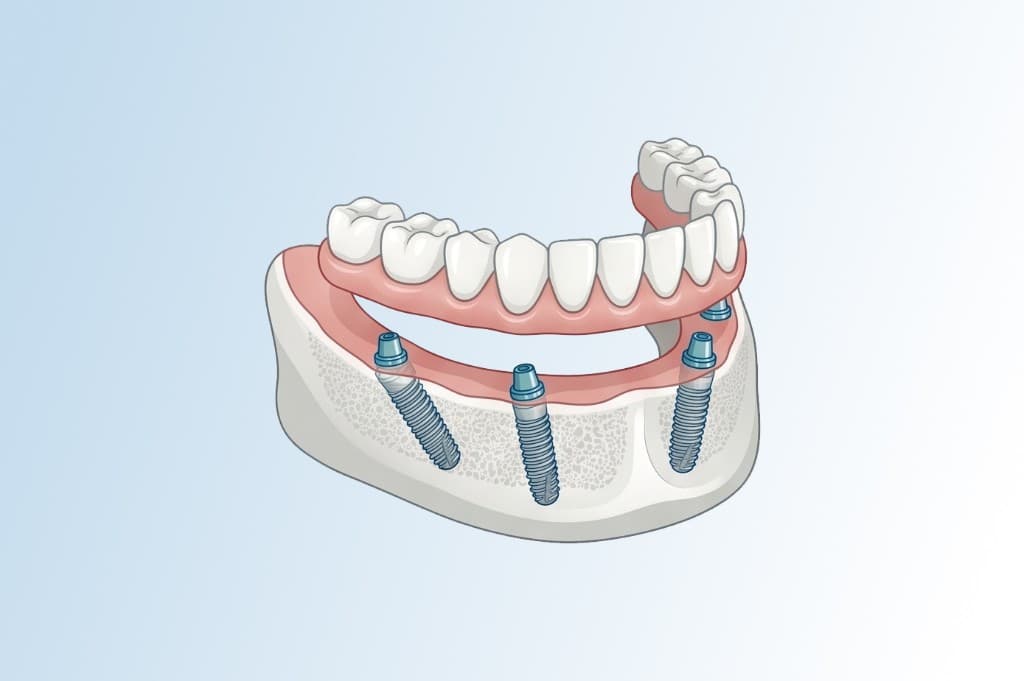 Schematische Darstellung All-on-4: Unterkiefer mit vier Implantaten und fester Zahnreihe auf Brückenkonstruktion